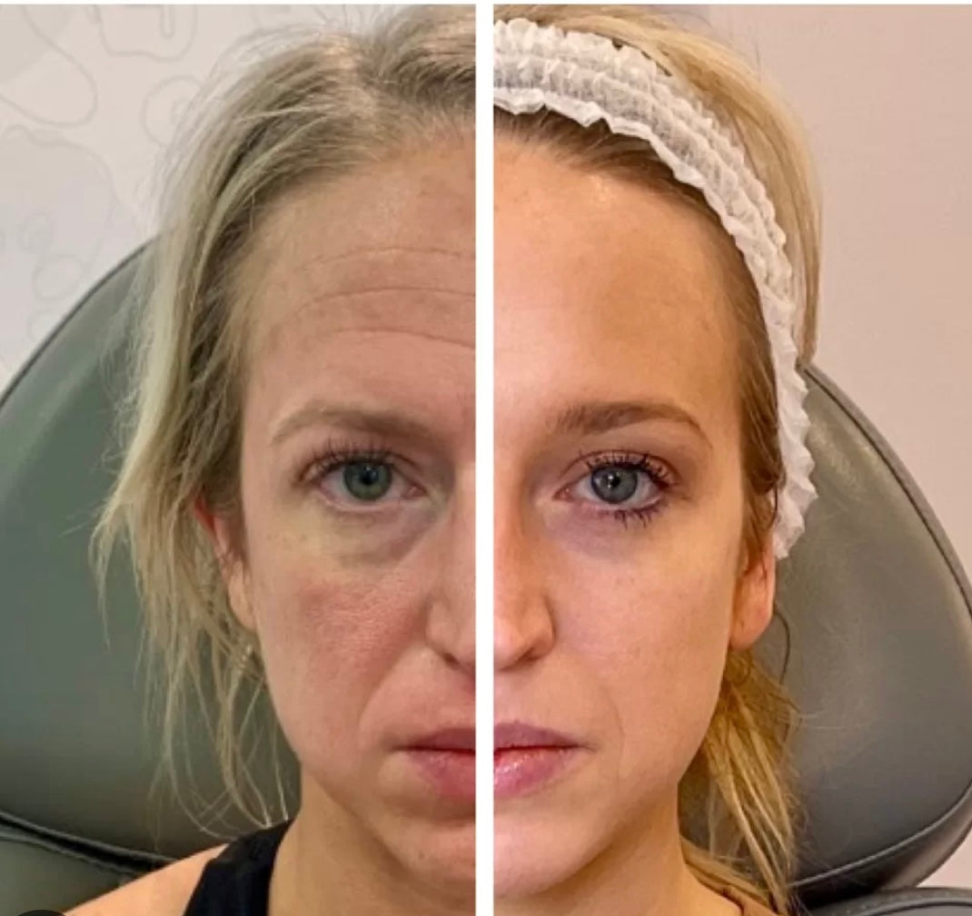 Sculptra Filler