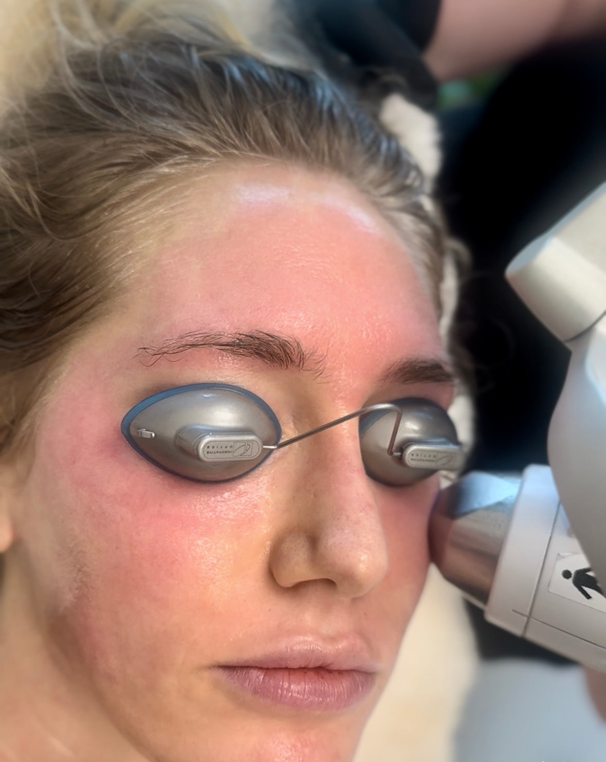 Avava Machine AVAVA Eyelid Rejuvenation – Skin Alchemy Memphis