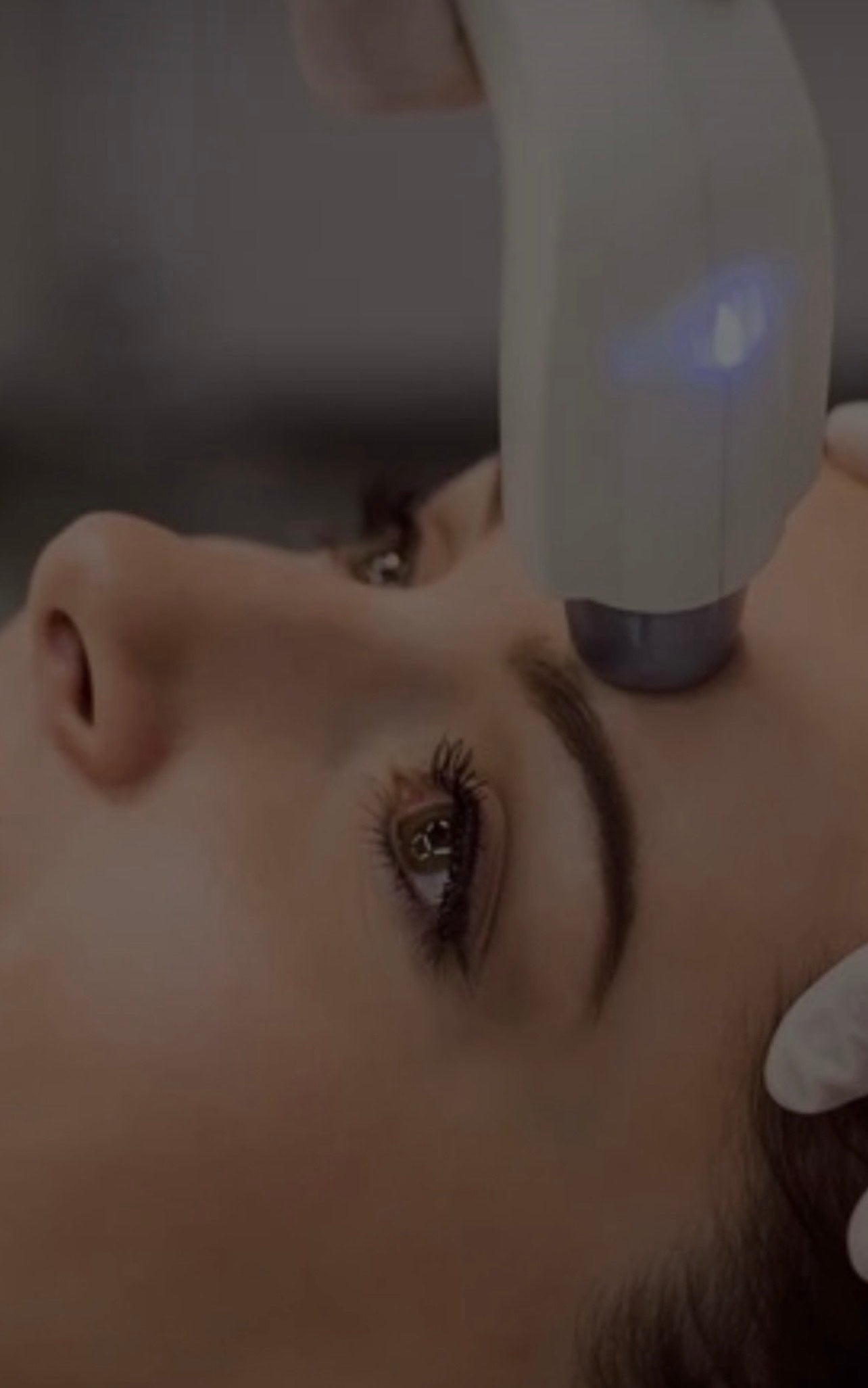 Lumecca IPL-Hands-1 treatment