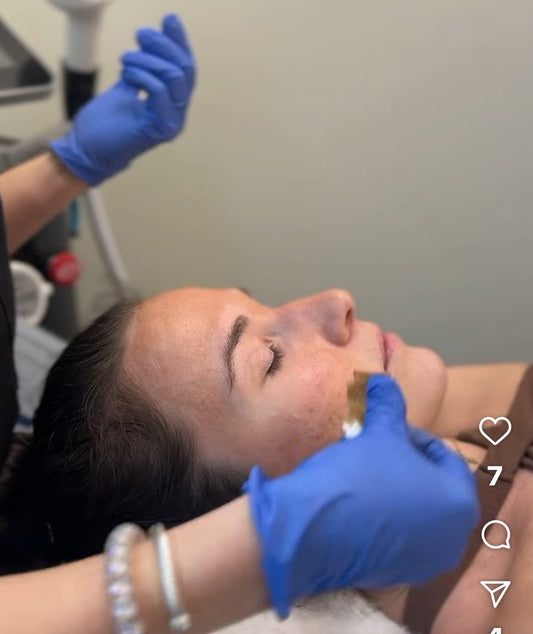 Deep Chemical Peel