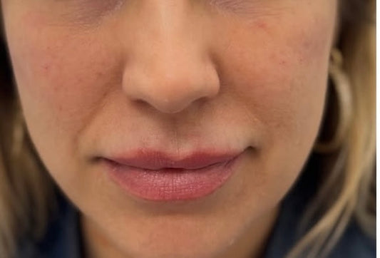 Voluma filler