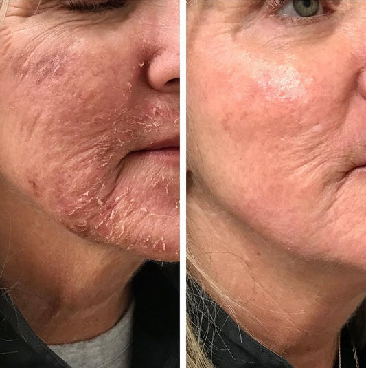 AGR Microneedling Reveal Peel