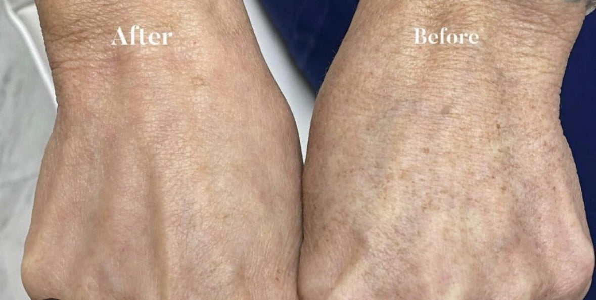 Lumecca IPL-Hands-1 treatment