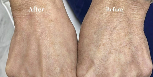 Lumecca IPL-Hands-1 treatment