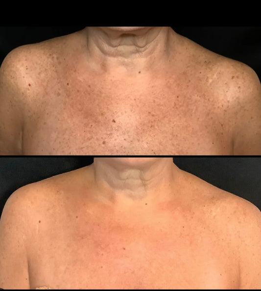 Lumecca IPL-Decollete PKG of 3