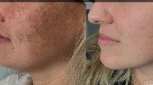 Lumecca IPL-1 treatment-face/neck