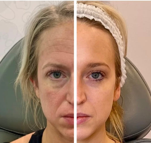 Sculptra Filler